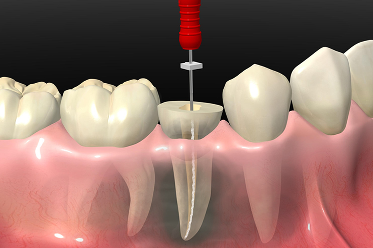 endodoncia